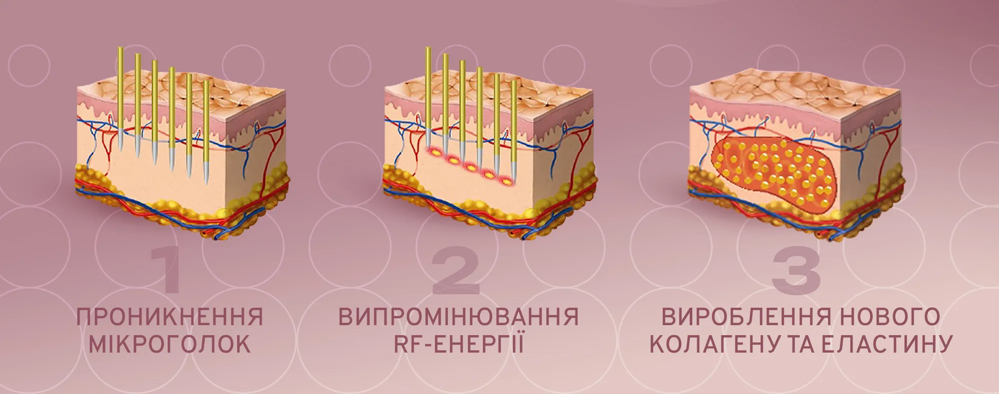 Апарат використовує насадку з тоненькими мікроголками, які входять у шкіру на глибину до 3,5 мм, створюючи контрольовані мікропошкодження в дермі, що запускає вироблення власного колагену та еластину.